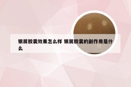 银屑胶囊效果怎么样 银屑胶囊的副作用是什么