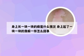 身上长一块一块的癣是什么情况 身上起了一块一块的像癣一样怎么回事