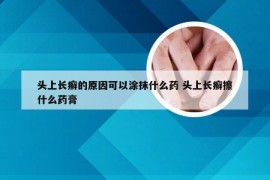 头上长癣的原因可以涂抹什么药 头上长癣擦什么药膏