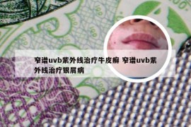 窄谱uvb紫外线治疗牛皮癣 窄谱uvb紫外线治疗银屑病