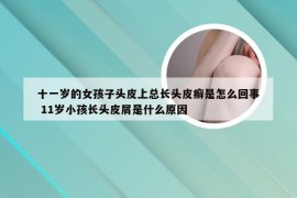 十一岁的女孩子头皮上总长头皮癣是怎么回事 11岁小孩长头皮屑是什么原因