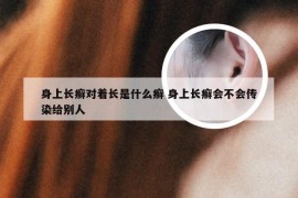 身上长癣对着长是什么癣 身上长癣会不会传染给别人