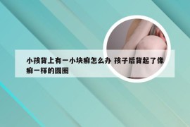 小孩背上有一小块癣怎么办 孩子后背起了像癣一样的圆圈