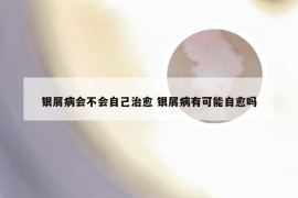 银屑病会不会自己治愈 银屑病有可能自愈吗