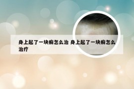 身上起了一块癣怎么治 身上起了一块癣怎么治疗