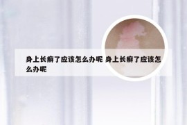 身上长癣了应该怎么办呢 身上长癣了应该怎么办呢