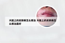 大腿上的皮肤癣怎么根治 大腿上的皮肤癣怎么根治最好