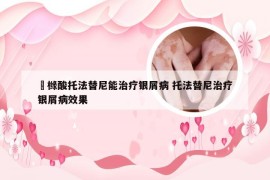 栒橼酸托法替尼能治疗银屑病 托法替尼治疗银屑病效果