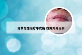 雄黄加醋治疗牛皮癣 雄黄外用治癣