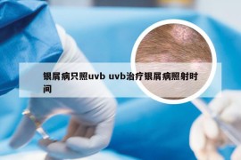 银屑病只照uvb uvb治疗银屑病照射时间