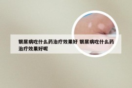 银屑病吃什么药治疗效果好 银屑病吃什么药治疗效果好呢