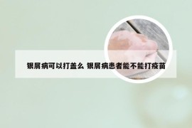 银屑病可以打盖么 银屑病患者能不能打疫苗