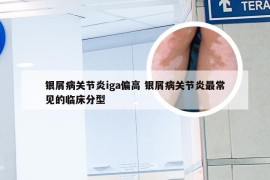 银屑病关节炎iga偏高 银屑病关节炎最常见的临床分型