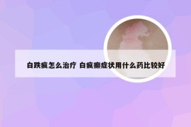 白跌疯怎么治疗 白疯癫症状用什么药比较好