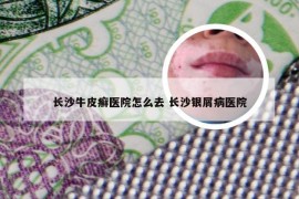 长沙牛皮癣医院怎么去 长沙银屑病医院