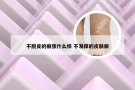 不脱皮的癣张什么样 不发痒的皮肤癣