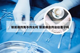 银屑病传男不传女吗 银屑病会传染给妻子吗