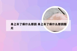 身上长了癣什么原因 身上长了癣什么原因图片