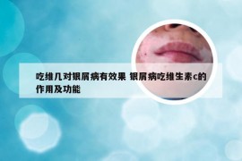 吃维几对银屑病有效果 银屑病吃维生素c的作用及功能