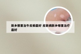 新乡那里治牛皮癣最好 皮肤病新乡哪里治疗最好