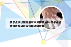 孩子点滴状银屑病可以涂抹精油吗 孩子点滴状银屑病可以涂抹精油吗视频