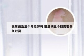 银屑病治三个月能好吗 银屑病三个期需要多久时间