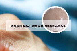 银屑病腿毛毛孔 银屑病会让腿毛长不出来吗