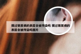 摸过银屑病的表层会被传染吗 摸过银屑病的表层会被传染吗图片