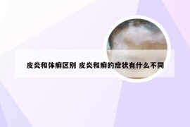 皮炎和体癣区别 皮炎和癣的症状有什么不同