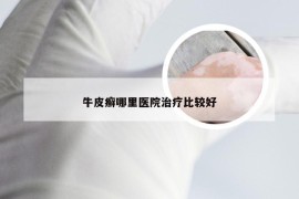 牛皮癣哪里医院治疗比较好