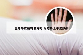 全身牛皮癣有偏方吗 治疗身上牛皮肤癣