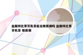 盐酸特比萘芬乳膏能治银屑病吗 盐酸特比萘芬乳膏 银屑病