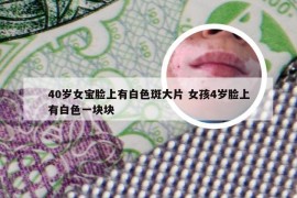 40岁女宝脸上有白色斑大片 女孩4岁脸上有白色一块块