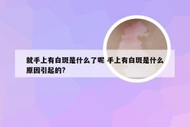 就手上有白斑是什么了呢 手上有白斑是什么原因引起的?