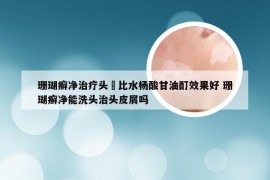 珊瑚癣净治疗头廯比水杨酸甘油酊效果好 珊瑚癣净能洗头治头皮屑吗