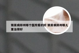 银屑病郑州哪个医院看的好 银屑病郑州哪儿里治得好