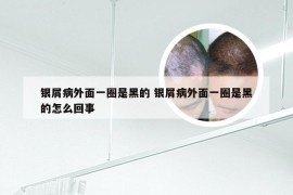 银屑病外面一圈是黑的 银屑病外面一圈是黑的怎么回事