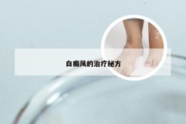 白癜风的治疗秘方