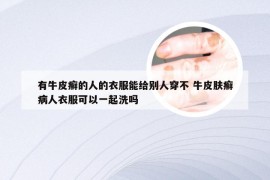 有牛皮癣的人的衣服能给别人穿不 牛皮肤癣病人衣服可以一起洗吗