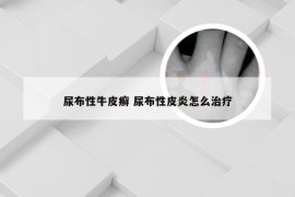 尿布性牛皮癣 尿布性皮炎怎么治疗