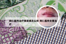 同仁医院治疗银屑病怎么样 同仁医院主要治疗