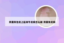 阴囊和包皮上起来牛皮癣怎么破 阴囊有皮癣