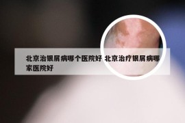 北京治银屑病哪个医院好 北京治疗银屑病哪家医院好