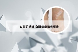 白斑的病症 白斑病症状有哪些