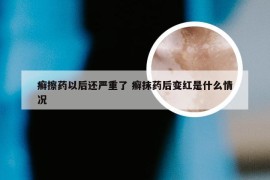 癣擦药以后还严重了 癣抹药后变红是什么情况