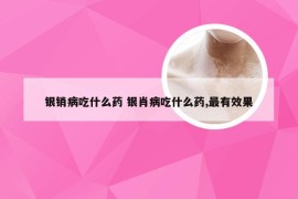 银销病吃什么药 银肖病吃什么药,最有效果