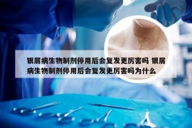 银屑病生物制剂停用后会复发更厉害吗 银屑病生物制剂停用后会复发更厉害吗为什么