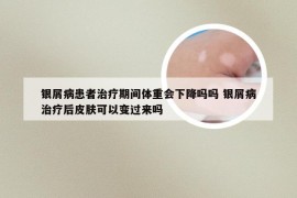 银屑病患者治疗期间体重会下降吗吗 银屑病治疗后皮肤可以变过来吗