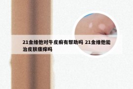 21金维他对牛皮癣有帮助吗 21金维他能治皮肤瘙痒吗