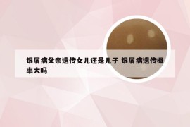 银屑病父亲遗传女儿还是儿子 银屑病遗传概率大吗